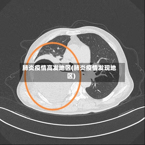 肺炎疫情高发地区(肺炎疫情发现地区)-第1张图片